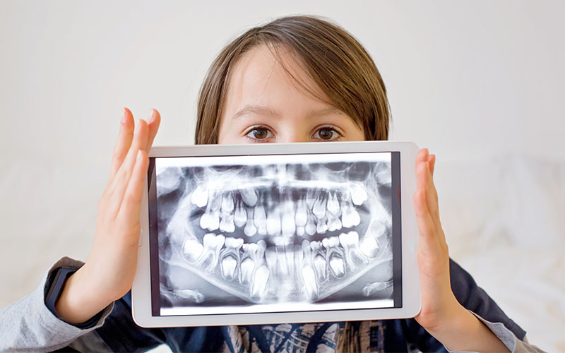 Griesbach Dental - Young patient holding an X-ray of their wisdom teeth